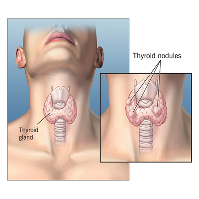 robotic thyroid surgery in hyderabad