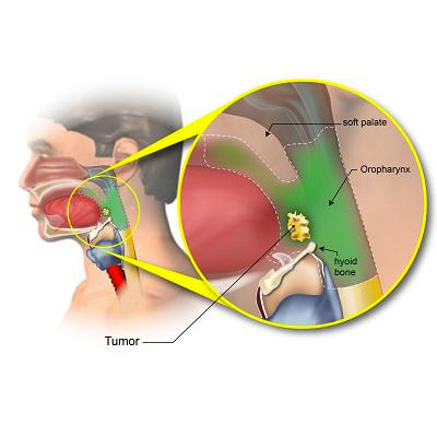 Throat Cancer Surgery in KPHB