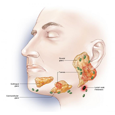 salivary gland cancer treatment