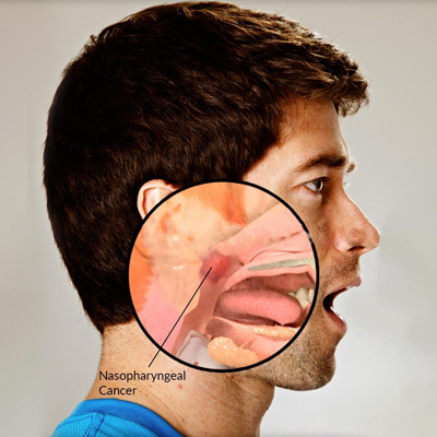 Throat Cancer Treatment