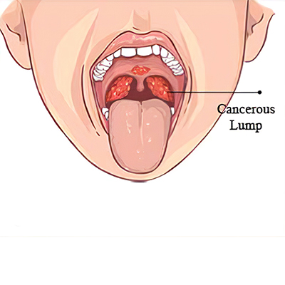 throat cancer surgery
