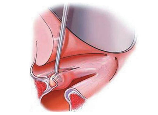 Voice box cancer treatment